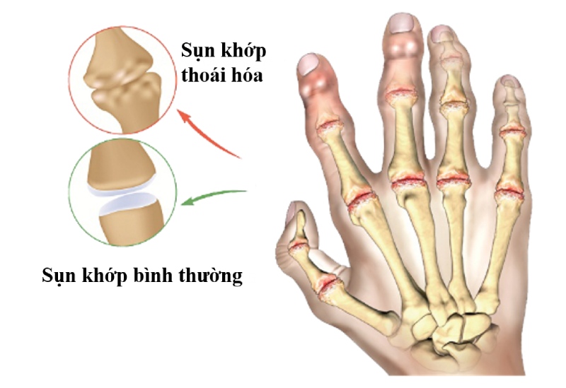 Nhận biết dấu hiệu thoái hóa khớp bàn tay và phòng ngừa cải thiện