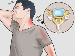Triệu chứng thoát vị đĩa đệm cổ lan ra vai và tay cảnh báo gì?