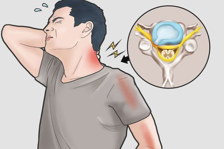 Triệu chứng thoát vị đĩa đệm cổ lan ra vai và tay cảnh báo gì?