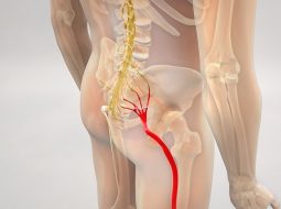 Nguyên nhân thoát vị đĩa đệm đau lan xuống chân và giải pháp