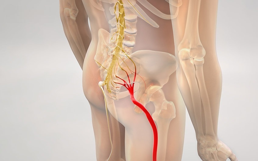Nguyên nhân thoát vị đĩa đệm đau lan xuống chân và giải pháp