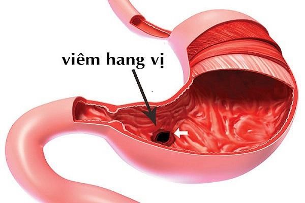 Viêm hang vị dạ dày: Chớ chủ quan với cơn đau âm ỉ
