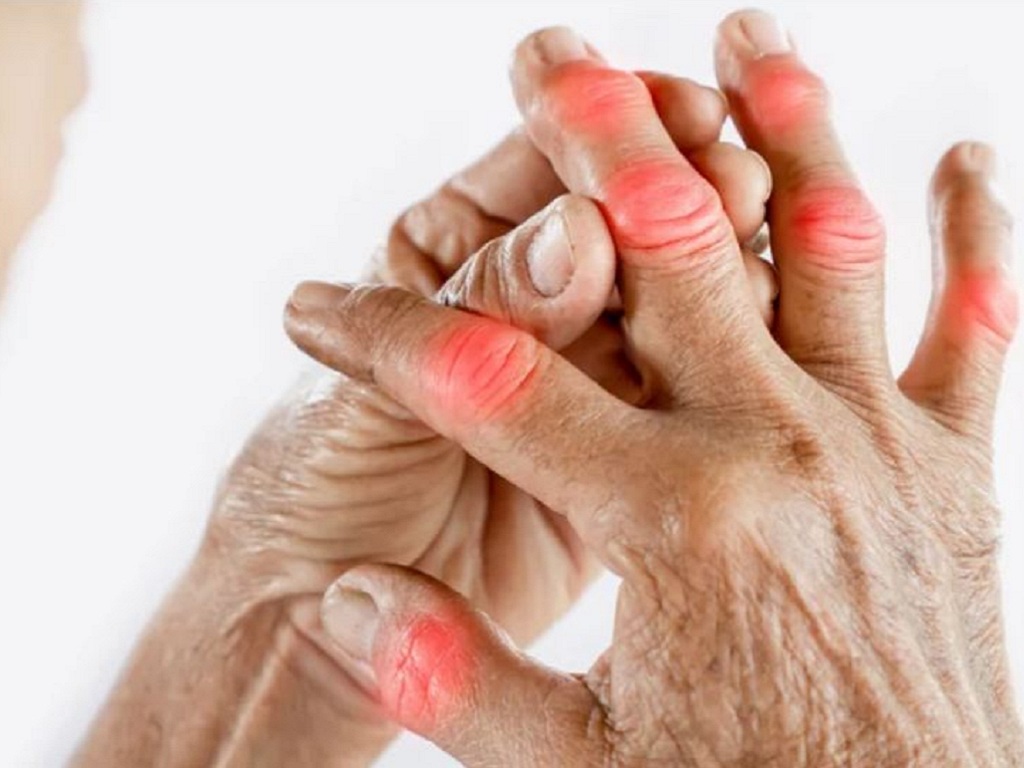 5 triệu chứng thường gặp của bệnh viêm xương khớp