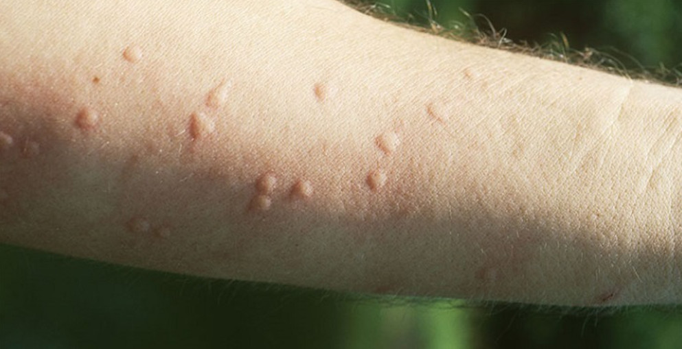 Nổi Mề Đay Có Được Ra Gió Không? Lời Khuyên Từ Lão Tuấn