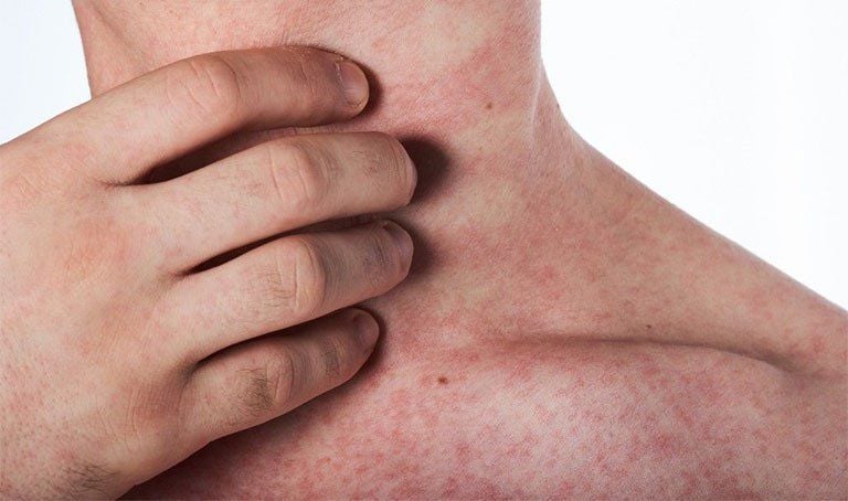 Sốt Nổi Mẩn Đỏ Ngứa – Những Điều Cần Biết và Cách Xử Lý Theo Y Học Cổ Truyền