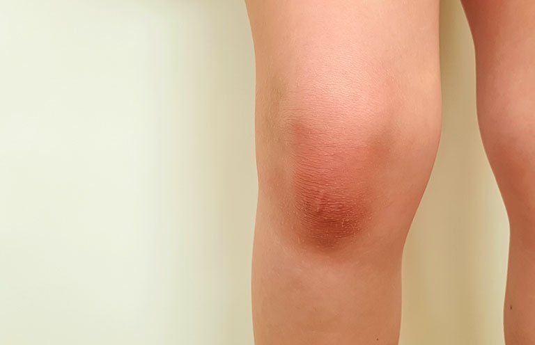 Tràn dịch khớp gối nên làm gì để không biến chứng lâu dài?