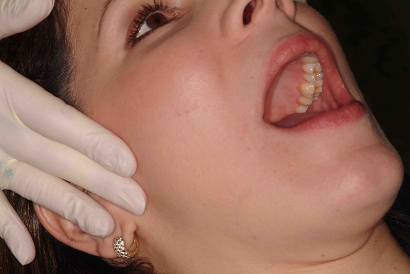 Trật khớp thái dương hàm có tự khỏi không?