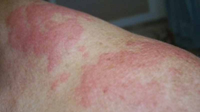 Sốt mề đay phát ban: Triệu chứng cảnh báo không thể xem nhẹ