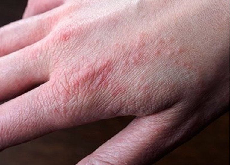 Mu bàn tay nổi mẩn đỏ ngứa - Nguyên nhân và cách điều trị hiệu quả