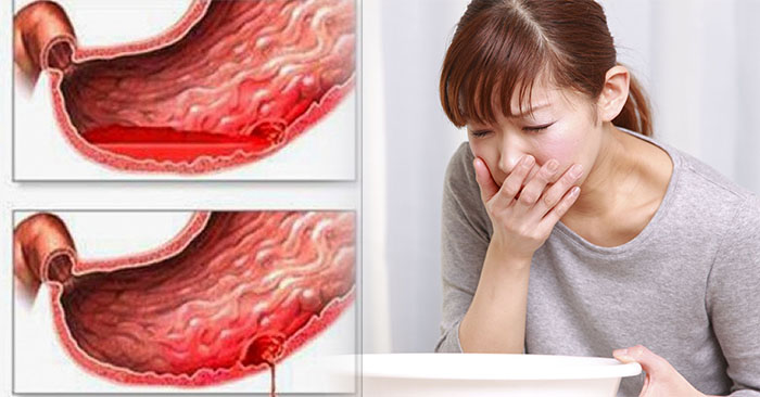 Viêm trợt dạ dày: Đừng để âm ỉ mà thành đại họa