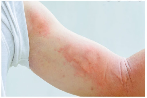 Tắm Xong Bị Nổi Mẩn Đỏ Ngứa: Nguyên Nhân Và Giải Pháp Từ Y Học Cổ Truyền