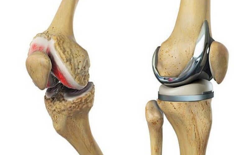 Viêm khớp nhiễm khuẩn: Hiểu để không chậm trễ điều trị