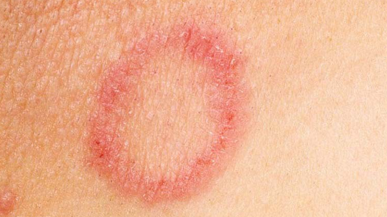 Da nổi mẩn đỏ ngứa hình tròn – Chớ chủ quan với dấu hiệu tưởng nhỏ