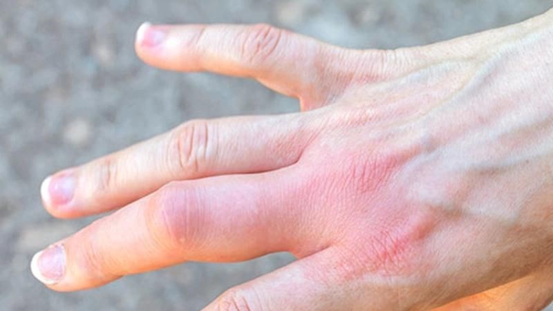 Sưng khớp ngón tay do viêm: Dấu hiệu nhỏ, hệ lụy lớn