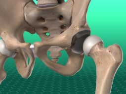 Sái khớp háng: Đừng để bước chân hóa thành nỗi đau