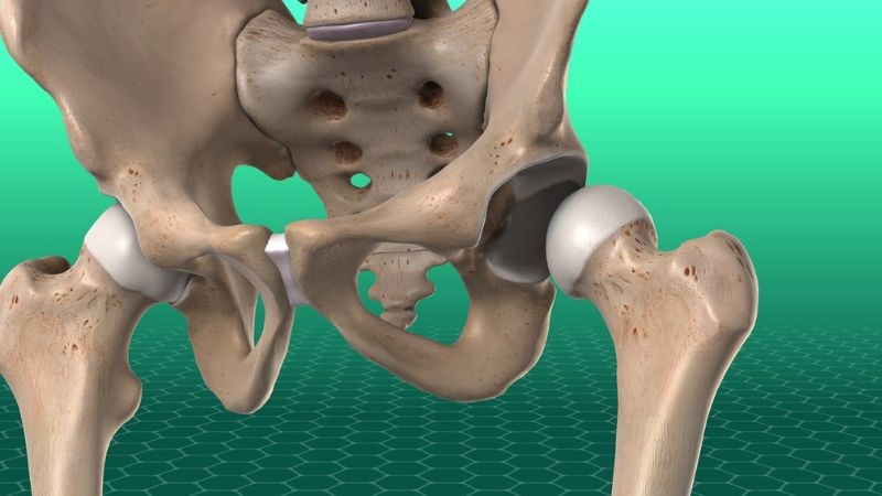 Sái khớp háng: Đừng để bước chân hóa thành nỗi đau