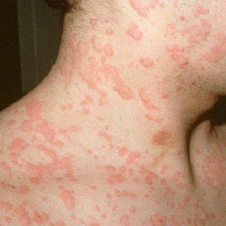 Sốt Nóng Lạnh Nổi Mề Đay: Triệu Chứng và Giải Pháp Điều Trị