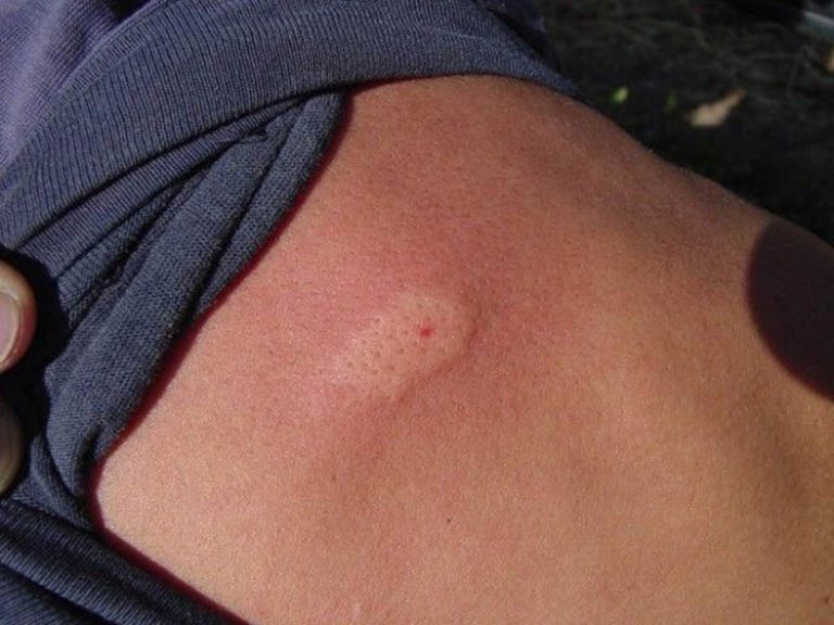 Bị Ong Đốt Nổi Mề Đay: Nguyên Nhân và Giải Pháp Từ Y Học Cổ Truyền