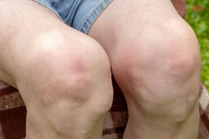 Biến dạng khớp gối – Dấu hiệu không nên xem thường