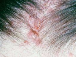 Da nổi mẩn đỏ ngứa hình tròn – Chớ chủ quan với dấu hiệu tưởng nhỏ