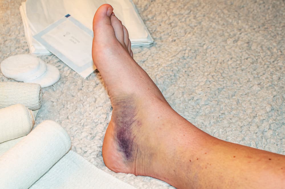 Trật khớp cổ chân nên làm gì để tránh biến chứng lâu dài?