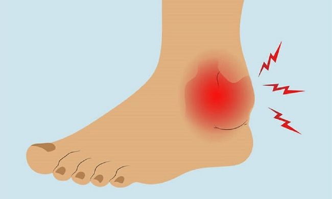 Dấu hiệu trật khớp mắt cá chân – Đừng coi thường cơn đau nhỏ