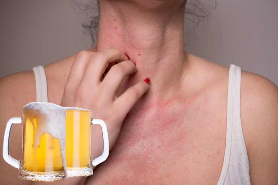 Uống Rượu Bị Nổi Mẩn Đỏ Ngứa – Cảnh Báo Và Cách Chữa Trị