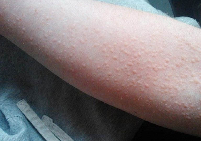 Ăn thịt bò bị nổi mề đay: Lý giải từ góc độ Y học cổ truyền