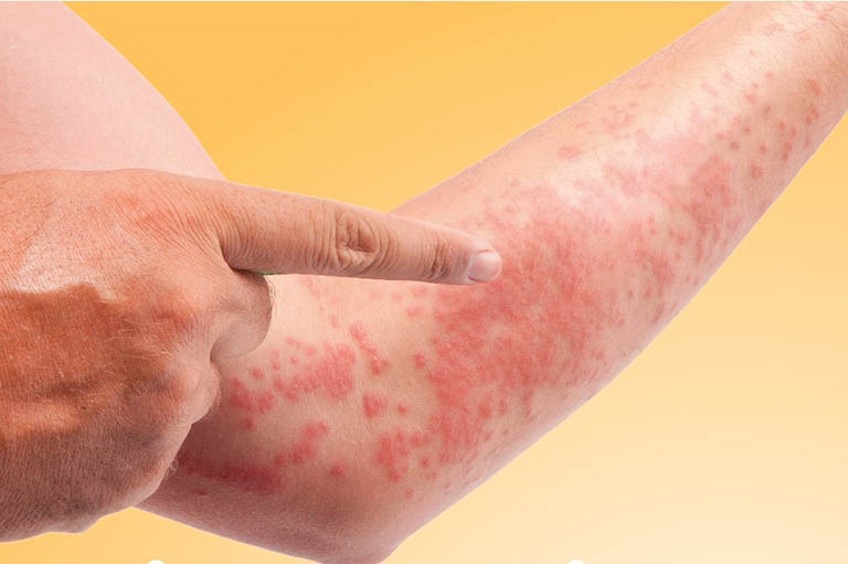 Nổi mẩn đỏ ngứa: Chớ chủ quan với triệu chứng tưởng như đơn giản