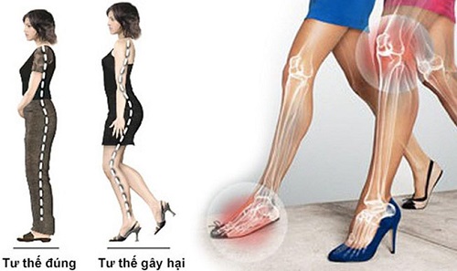 Ảnh hưởng của giày cao gót lên cột sống: Đừng xem thường!