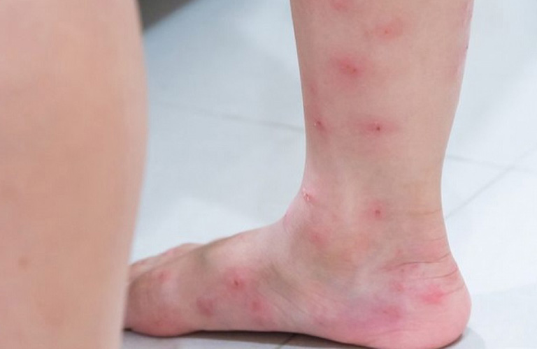 Nổi mẩn ngứa ở bắp chân: Nguyên nhân và cách chăm sóc theo Đông y