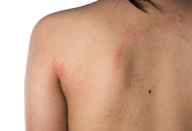 Lưng nổi mẩn đỏ ngứa: Chia sẻ từ Lão Tuấn về triệu chứng và chăm sóc