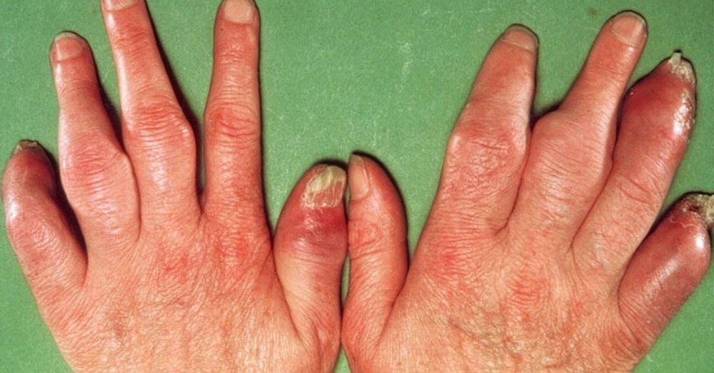 Viêm khớp vảy nến: Căn bệnh ngoài da, đau xương, tổn thương từ gốc