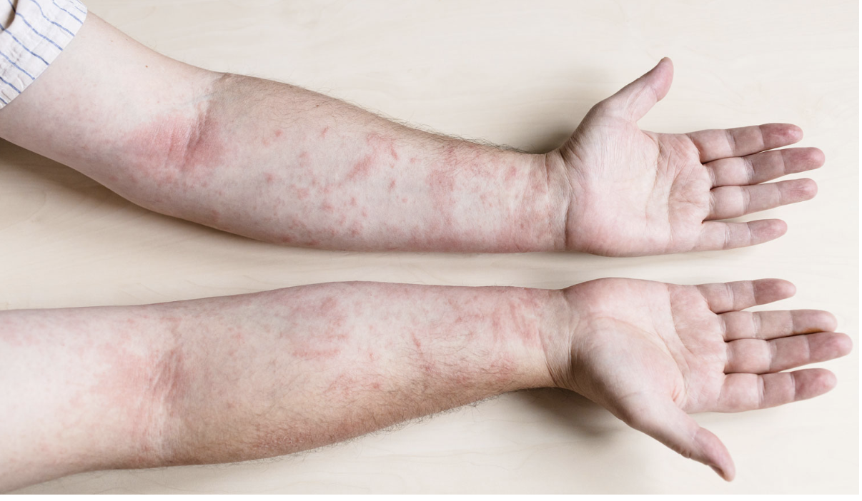 Nổi mẩn ngứa do dị ứng: nguyên nhân và biện pháp khắc