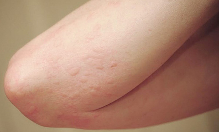 Nổi mẩn ngứa ở khuỷu tay đầu gối: Nguyên nhân và cách xử lý từ Y học cổ truyền