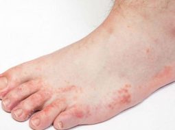 Mẩn ngứa mu bàn chân: Dấu hiệu nhỏ, cảnh báo bệnh không nhỏ