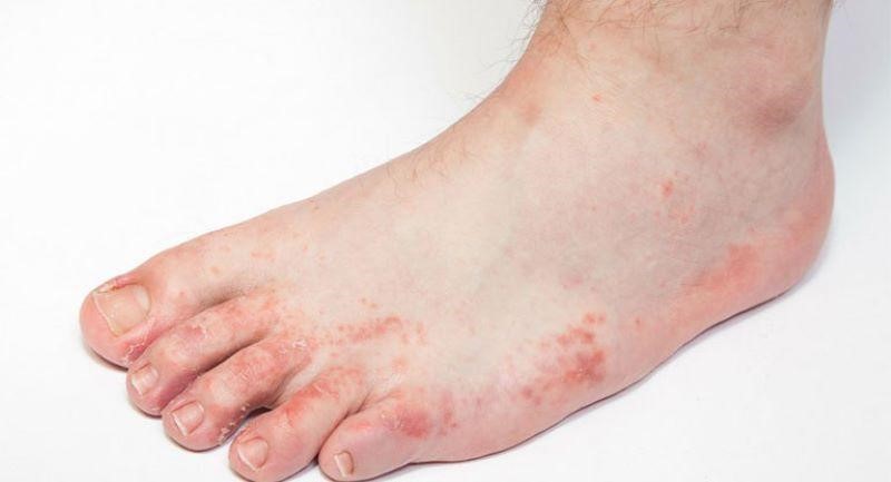 Mẩn ngứa mu bàn chân: Dấu hiệu nhỏ, cảnh báo bệnh không nhỏ