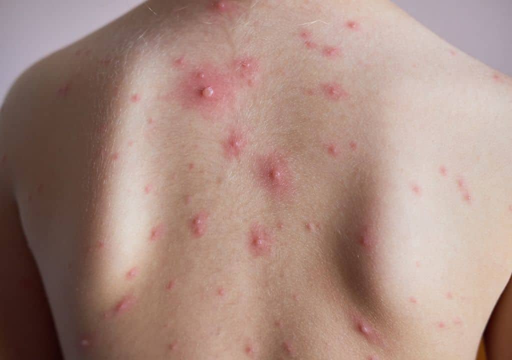 Nóng gan nổi mẩn ngứa phải làm sao? Lão Tuấn hướng dẫn chăm sóc tại nhà