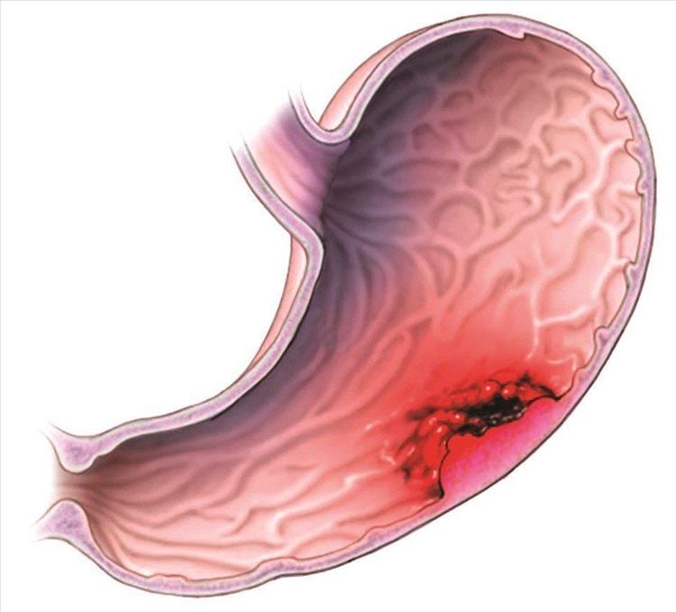 Viêm loét dạ dày để lâu có sao không?