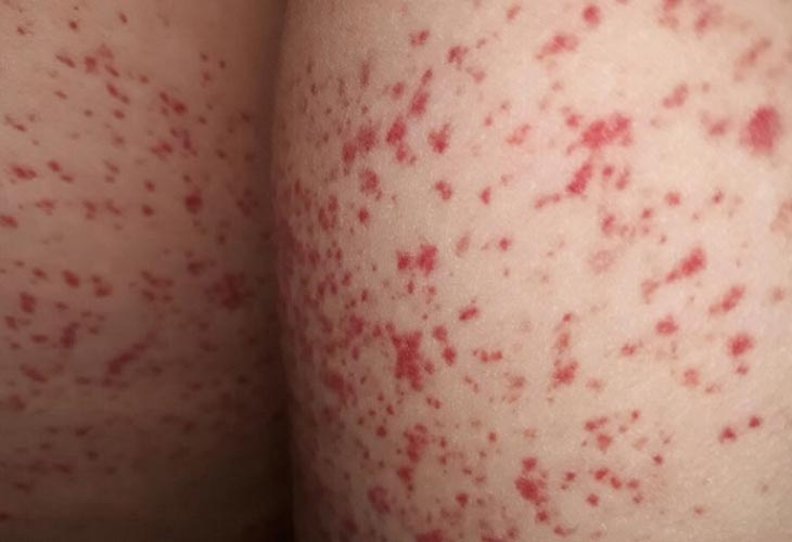 nổi mẩn ngứa ở mông – triệu chứng và cách điều trị hiệu quả theo y học cổ truyền