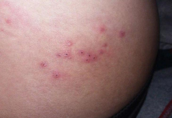 Cách trị nổi mẩn ngứa ở mông hiệu quả từ Y học cổ truyền