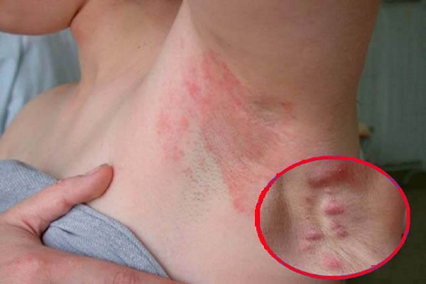 Cách trị nách bị ngứa nổi mẩn đỏ tại nhà theo Đông y