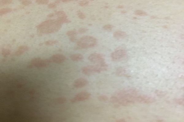 Những Dấu Hiệu Cảnh Báo Nổi Mẩn Đỏ Hình Tròn Không Ngứa Và Cách Nhận Biết