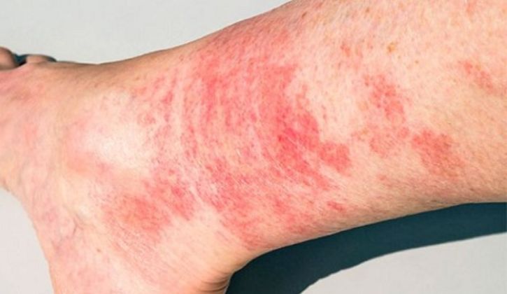 Nổi mẩn ngứa ở chân: Lão Tuấn chia sẻ cách nhận biết và chăm sóc