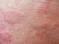 Nổi mẩn đỏ ngứa sau khi quan hệ: Cảnh giác dấu hiệu bệnh lý từ Lão Tuấn