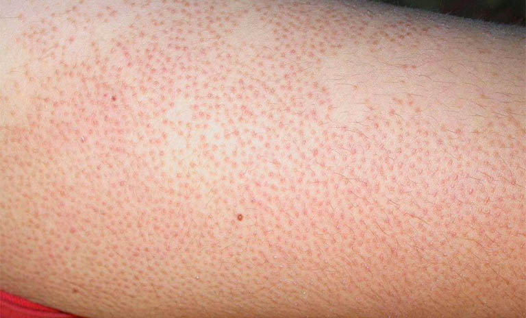 Chân nổi mẩn đỏ li ti không ngứa: Nguyên nhân và cách phòng ngừa