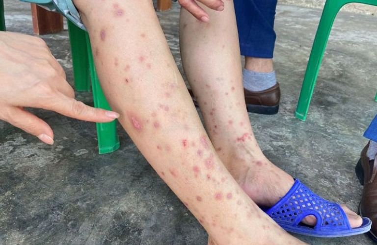 Chân nổi mẩn đỏ ngứa như muỗi đốt – Nguyên nhân và Giải pháp hiệu quả từ Y học cổ truyền