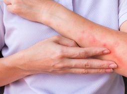 Nổi mẩn ngứa ở khuỷu tay: Cẩn trọng phong nhiệt tích tụ và cách đẩy lùi từ gốc