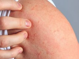 Nổi mề đay có tự hết không và cách chăm sóc tại nhà cho bà con