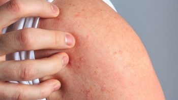 Nổi mề đay có tự hết không và cách chăm sóc tại nhà cho bà con